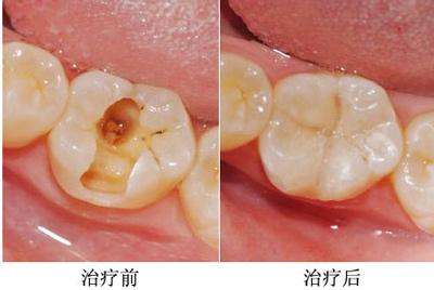 南京补牙洞多少钱？