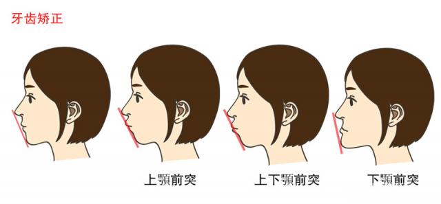 隐形矫正的过程