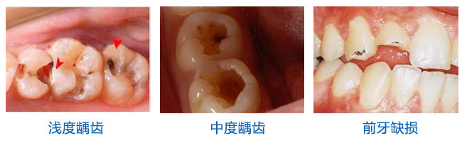 牙齿涂氟多少钱一次