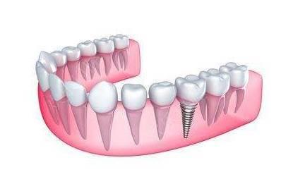 一颗种植牙的费用是多少