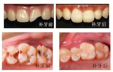 拔牙补牙一般多少钱?