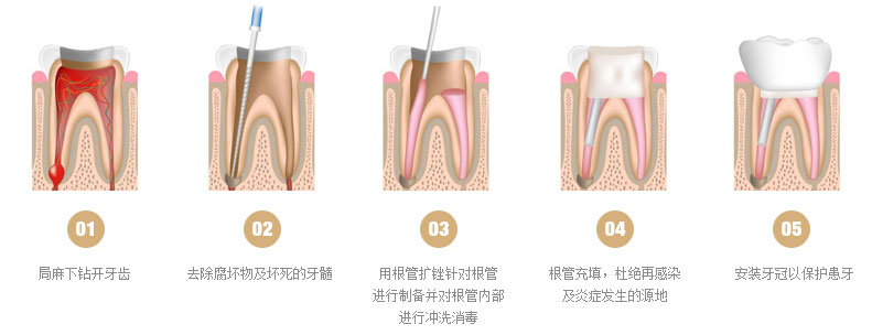 根管治疗多久不能吃东西