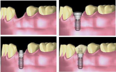 种植牙分几个步骤?
