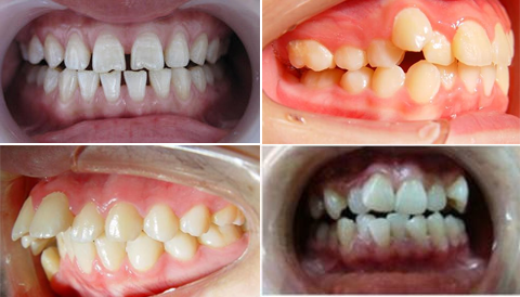 门牙不齐最快矫正方法