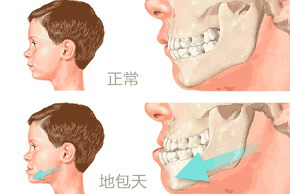 如何矫正地包天