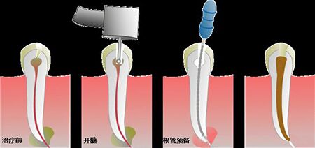 怎么样做根管治疗