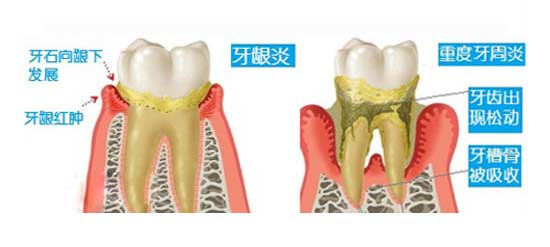 老人牙疼牙肿吃什么药最管用