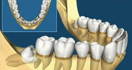 不是所有智齿都要拔掉